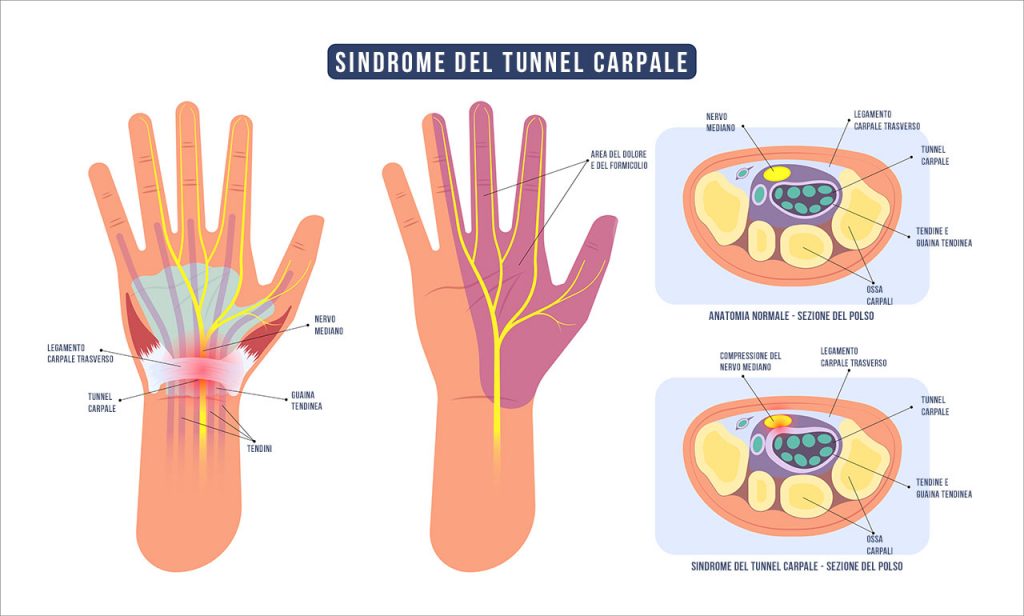 anatomia-sindrome-tunnel-carpale